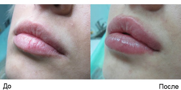 Căng da mặt bằng lưới 3D cho khuôn mặt, môi, trán, bụng. Trước và sau hình ảnh, đánh giá, giá của thủ tục