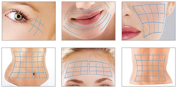 Căng da mặt bằng lưới 3D cho khuôn mặt, môi, trán, bụng. Trước và sau hình ảnh, đánh giá, giá của thủ tục