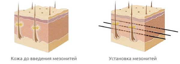 Căng da mặt bằng lưới 3D cho khuôn mặt, môi, trán, bụng. Trước và sau hình ảnh, đánh giá, giá của thủ tục