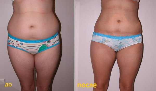 Máy hút bụng. Cách tập đúng bài, kỹ thuật giảm cân, bơm căng, hóp bụng sau sinh