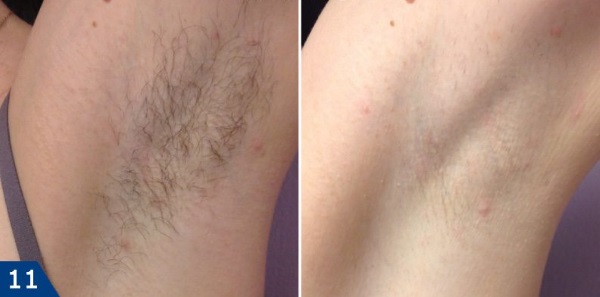 AFT triệt lông - triệt lông bằng laser trên mặt và cơ thể, vùng bikini tại thẩm mỹ viện và tại nhà. Thiết bị, đánh giá và giá cả