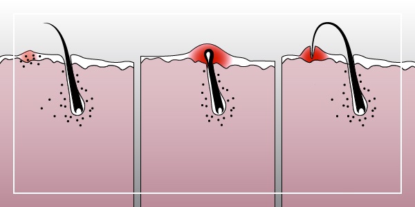 AFT triệt lông - triệt lông bằng laser trên mặt và cơ thể, vùng bikini tại thẩm mỹ viện và tại nhà. Thiết bị, đánh giá và giá cả