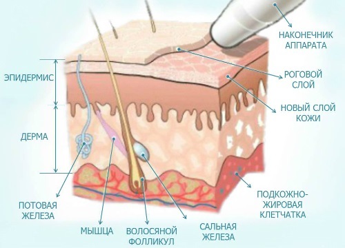 Diamante microdermoabrasão facial - o que é, aparelhos, cremes para micropeeling enzimático. Preço do procedimento