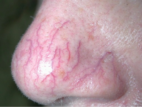 Diamante microdermoabrasão facial - o que é, aparelhos, cremes para micropeeling enzimático. Preço do procedimento