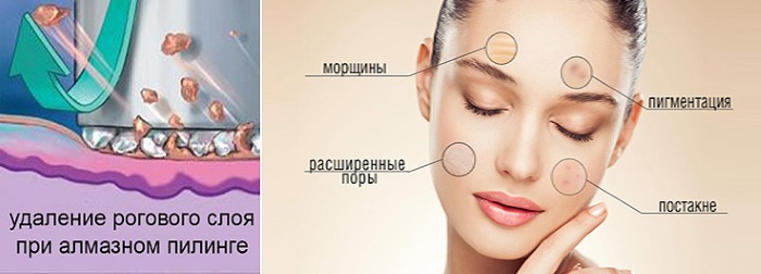 Diamante microdermoabrasão facial - o que é, aparelhos, cremes para micropeeling enzimático. Preço do procedimento