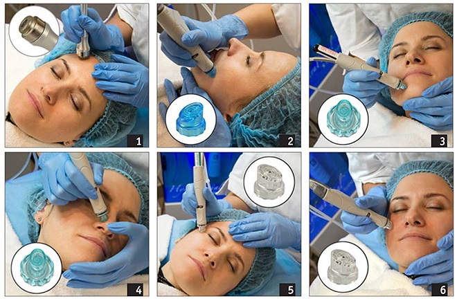 Diamante microdermoabrasão facial - o que é, aparelhos, cremes para micropeeling enzimático. Preço do procedimento