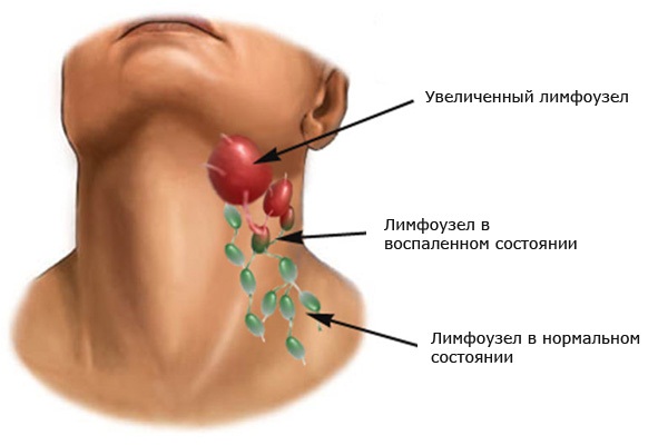 Latihan EMS (EMS) - apa itu, faedah dan kemudaratan, hasil, gambar, ulasan doktor mengenai myostimulation