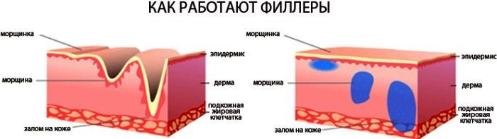 Пунила у назолабијалним наборима, испод очију, на уснама, у јагодицама. Корекција носа, назолакримални жлеб. Обликовање лица