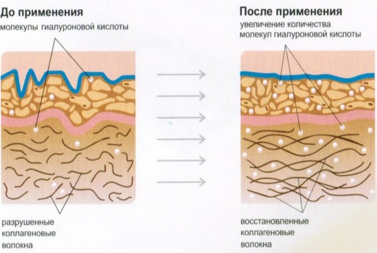 Пунила у насолабијалним наборима, испод очију, на уснама, у јагодицама. Корекција носа, назолакримални жлеб. Обликовање лица