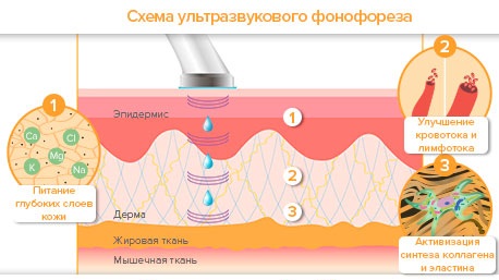 Fonoforesis wajah dengan hidrokortison, caripain, asid hyaluronik. Petunjuk dan kontraindikasi, alat untuk prosedur ultrasound