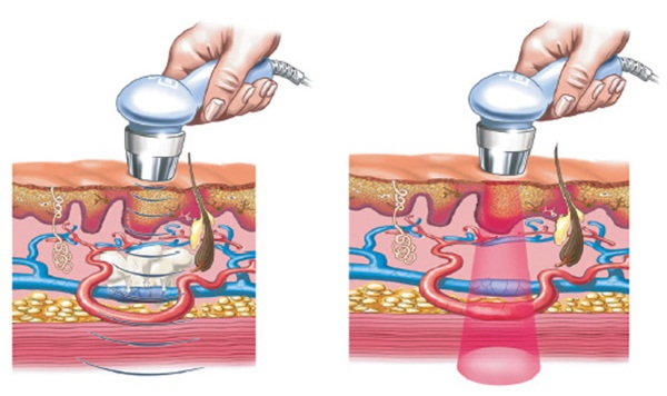 Fonoforesis wajah dengan hidrokortison, caripain, asid hyaluronik. Petunjuk dan kontraindikasi, alat untuk prosedur ultrasound
