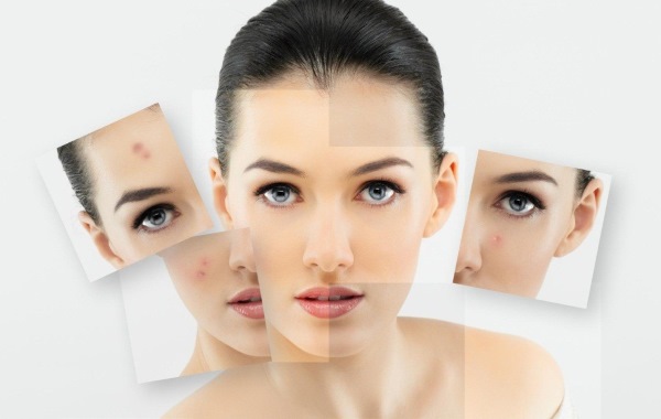 Khí-lỏng lột mặt. Nó là gì, chỉ định, chống chỉ định. Ứng dụng cho thai kỳ, mụn trứng cá, bệnh trứng cá đỏ. Trước và sau ảnh, đánh giá