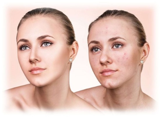 Khí-lỏng lột mặt. Nó là gì, chỉ định, chống chỉ định. Ứng dụng cho thai kỳ, mụn trứng cá, bệnh trứng cá đỏ. Trước và sau ảnh, đánh giá