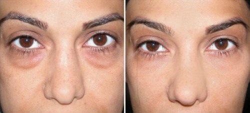 Thuốc mỡ heparin cho mặt trong thẩm mỹ. Thuộc tính và ứng dụng cho các nếp nhăn, vết thâm, túi, bọng dưới mắt