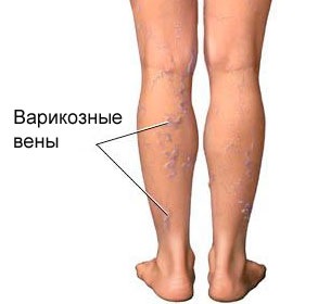 Thuốc mỡ heparin cho các nếp nhăn dưới mắt. Hướng dẫn sử dụng, cách áp dụng, đánh giá của chuyên gia thẩm mỹ