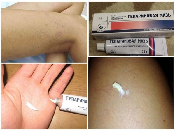 Thuốc mỡ heparin cho các nếp nhăn dưới mắt. Hướng dẫn sử dụng, cách áp dụng, đánh giá của chuyên gia thẩm mỹ