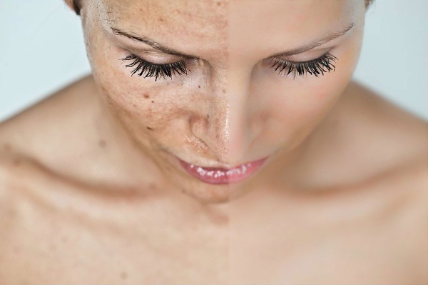 Qué es la hidroquinona, aplicación en cosmetología: cremas blanqueadoras, peeling, pomadas, tabletas. Achroactive max, opiniones