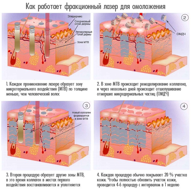 Laser phân đoạn trẻ hóa da mặt, da toàn thân. Clear Brilliant, Hoa Kỳ. Ưu nhược điểm, đánh giá