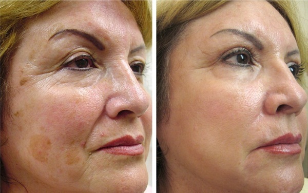 Laser làm trẻ hóa da mặt, da toàn thân. Clear Brilliant, Hoa Kỳ. Ưu nhược điểm, đánh giá