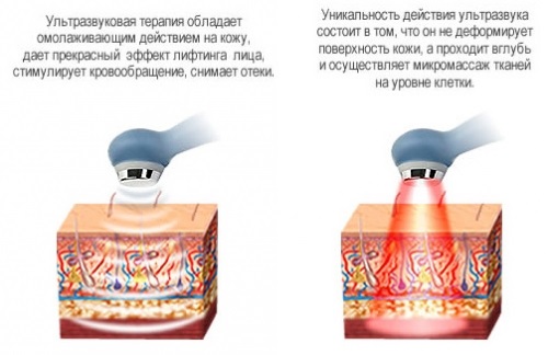 Лифтинг лица: шта је то, СМАС, РФ, плазма, масажа, ултразвук, филамент, ендоскопски, радио талас, вектор, радио фреквенција, ласер, акупунктура