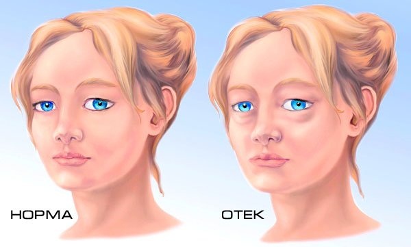 Lipolitik untuk muka, dagu, hidung. Hasil permohonan, harga, kesan sampingan suntikan mesoterapi