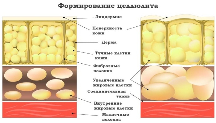 Медена масажа за целулит. Како то учинити исправно за мршављење на стомаку, леђима, ногама, задњици код куће. Видео лекције