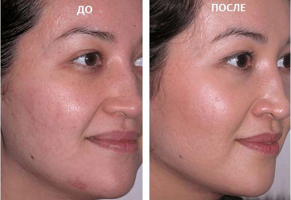 Sữa rửa mặt. Hóa chất Glycolic tốt nhất: Arabia, Compliment, Martinex, Gigi, Holy Land. Nhận xét