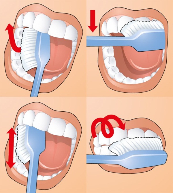 Thao tác loại bỏ các cục của Bish. Nó diễn ra như thế nào, cái giá phải trả, hậu quả ở tuổi già