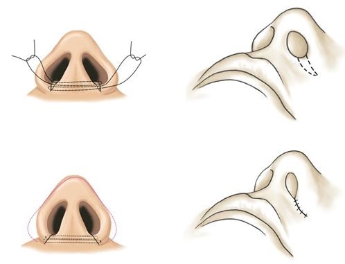 Phẫu thuật thẩm mỹ mũi. Chủng loại, giá cả: chỉnh sửa vách ngăn, thu gọn cánh mũi, xóa hếch, tạo hình lại, nâng mũi
