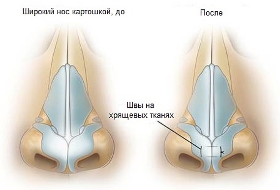 Phẫu thuật thẩm mỹ mũi. Chủng loại, giá cả: chỉnh sửa vách ngăn, thu gọn cánh mũi, xóa hếch, tạo hình lại, nâng mũi