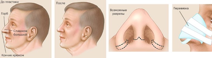 Phẫu thuật thẩm mỹ mũi. Chủng loại, giá cả: chỉnh sửa vách ngăn, thu gọn cánh mũi, xóa hếch, tạo hình lại, nâng mũi