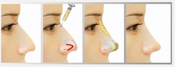 Phẫu thuật thẩm mỹ mũi. Chủng loại, giá cả: chỉnh sửa vách ngăn, thu gọn cánh mũi, xóa hếch, tạo hình lại, nâng mũi