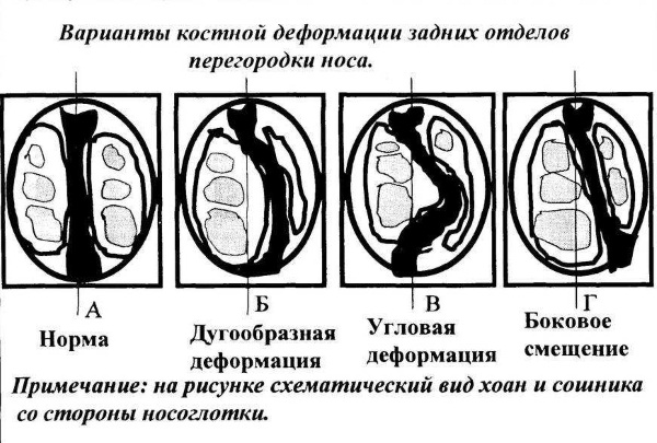 Phẫu thuật thẩm mỹ mũi. Chủng loại, giá cả: chỉnh sửa vách ngăn, thu gọn cánh mũi, xóa hếch, tạo hình lại, nâng mũi