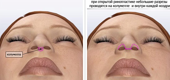 Phẫu thuật thẩm mỹ mũi. Chủng loại, giá cả: chỉnh sửa vách ngăn, thu gọn cánh mũi, xóa hếch, tạo hình lại, nâng mũi