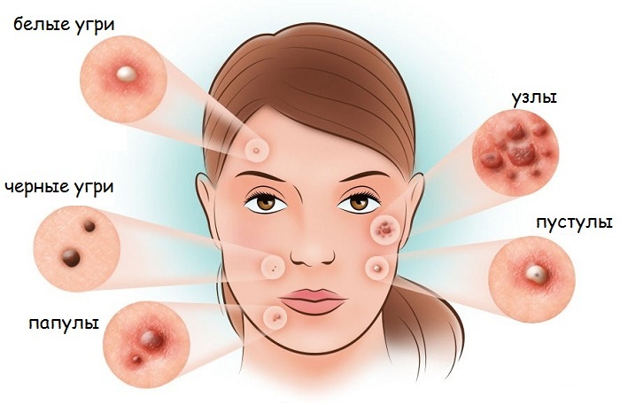Mụn ở cằm ở phụ nữ trên mặt. Nguyên nhân xuất hiện sau 30 năm, khi mang thai. Cơ quan nào bị lỗi, cách khắc phục tại nhà