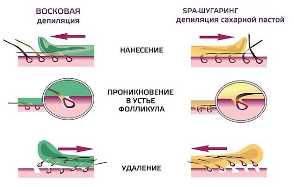 Sáp làm rụng lông hay tạo đường? Diện bikini thâm, chân, nách còn gì tuyệt hơn.