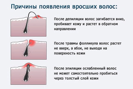 Sáp làm rụng lông hay tạo đường? Diện bikini thâm, chân, nách còn gì tuyệt hơn.