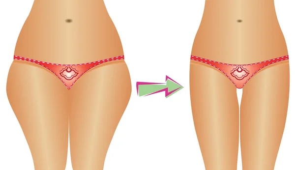 Làm thế nào để loại bỏ tai trên đùi trong một tuần: bài tập, hút mỡ, massage giác hơi, quấn