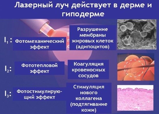 Liposuction laser. Apa itu, bagaimana ia dilakukan untuk perut, dagu, muka, paha, pipi, kaki, punggung, lengan, bonggol janda. Sebelum dan selepas gambar, ulasan, harga prosedur