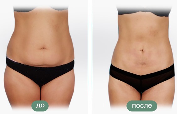 Liposuction laser. Apa itu, bagaimana ia dilakukan untuk perut, dagu, muka, paha, pipi, kaki, punggung, lengan, bonggol janda. Sebelum dan selepas gambar, ulasan, harga prosedur