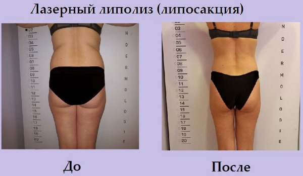 Liposuction laser. Apa itu, bagaimana ia dilakukan untuk perut, dagu, muka, paha, pipi, kaki, punggung, lengan, bonggol janda. Sebelum dan selepas gambar, ulasan, harga prosedur