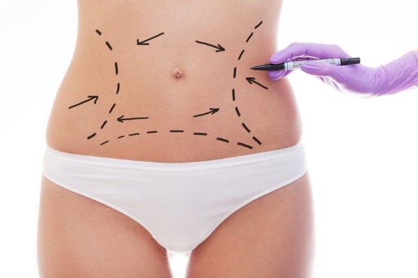 Liposuction laser. Apa itu, bagaimana ia dilakukan untuk perut, dagu, muka, paha, pipi, kaki, punggung, lengan, bonggol janda. Sebelum dan selepas gambar, ulasan, harga prosedur