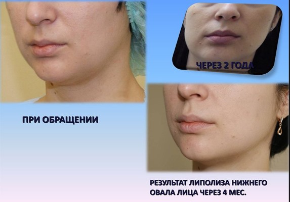 Liposuction laser.Apa itu, bagaimana ia dilakukan untuk perut, dagu, muka, paha, pipi, kaki, punggung, lengan, bonggol janda. Sebelum dan selepas gambar, ulasan, harga prosedur