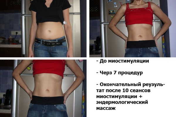 Миостимуланти за лице и тело у козметологији. Поступци, уређаји, контраиндикације, прегледи лекара