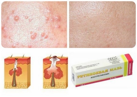 Retinoids tại chỗ, toàn thân, tại chỗ, bên ngoài cho mặt đối với mụn trứng cá, nếp nhăn, mụn trứng cá, bệnh vẩy nến. Viên nén, kem, thuốc mỡ, nước thơm