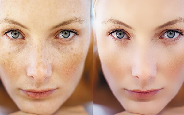Retinoids tại chỗ, toàn thân, tại chỗ, bên ngoài cho mặt đối với mụn trứng cá, nếp nhăn, mụn trứng cá, bệnh vẩy nến. Viên nén, kem, thuốc mỡ, nước thơm