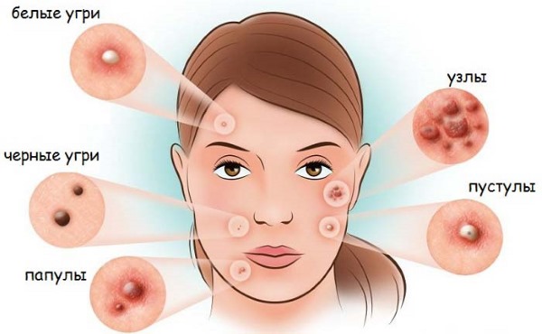 Retinoids tại chỗ, toàn thân, tại chỗ, bên ngoài cho mặt đối với mụn trứng cá, nếp nhăn, mụn trứng cá, bệnh vẩy nến. Viên nén, kem, thuốc mỡ, nước thơm