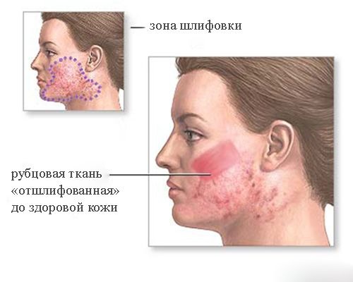 Tái tạo bề mặt. Ảnh trước và sau laser, CO2, kim cương, phân số, tần số vô tuyến. Ưu và nhược điểm, các giai đoạn, phục hồi