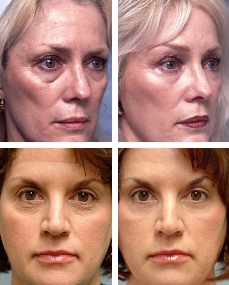 Solcoseryl dalam kosmetologi untuk wajah dari kerutan, lebam di bawah mata. Arahan penggunaan, ulasan pakar kosmetik