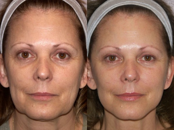 ดึงหน้าแบบไม่ต้องผ่าตัดกับ Margarita Levchenko บทเรียนวิดีโอการฝึกอบรมประโยชน์ของวิธีการ